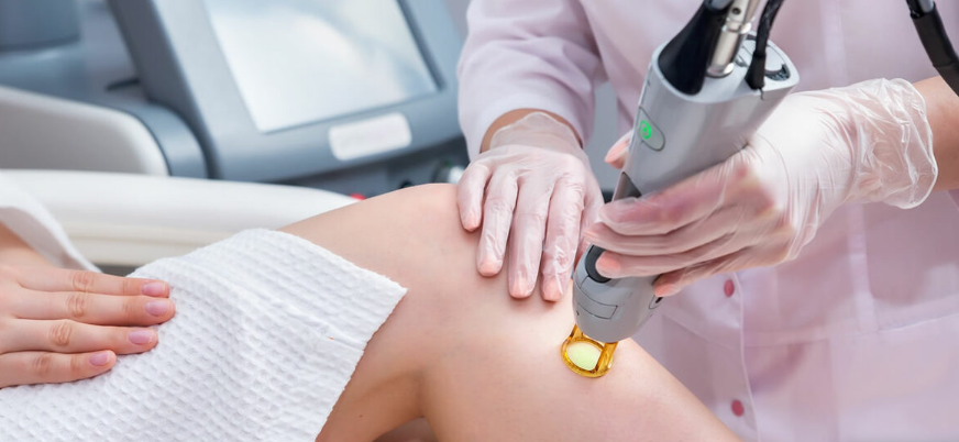 Лазерная, Лазерная эпиляция